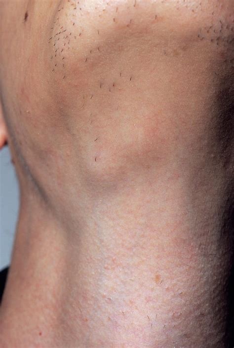 inguinal enlarged lymph nodes